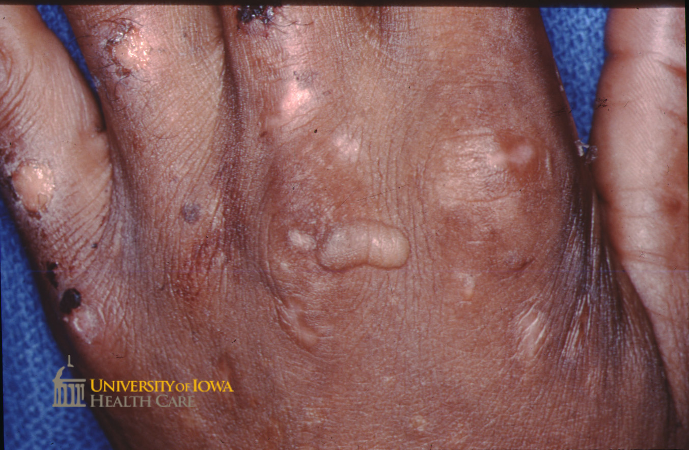Bullae, atrophic scars, and crusting on the dorsal hands. (click images for higher resolution).